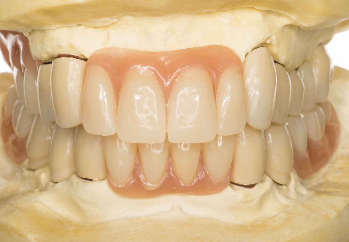 Prótese Dentária