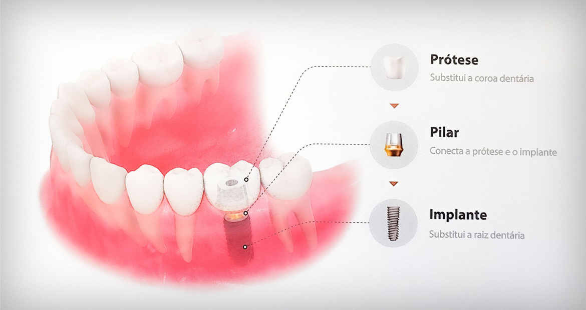 Implantes Dentários